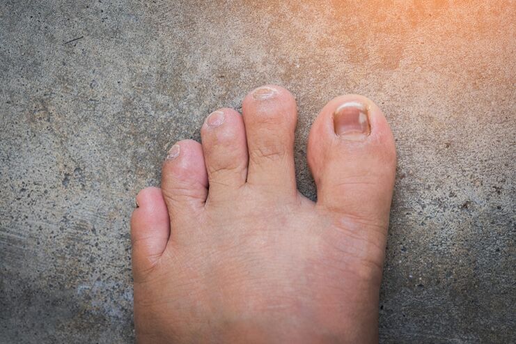 Nail fungus