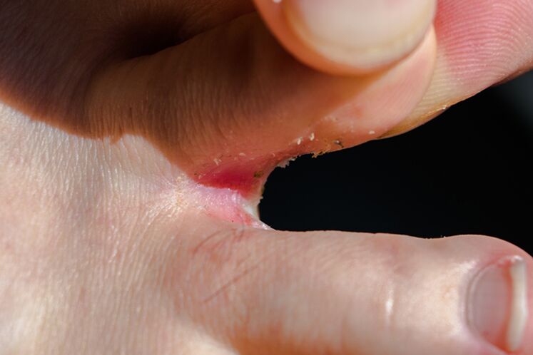 Trichopyosis