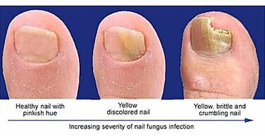 The manifestation of the nail fungus