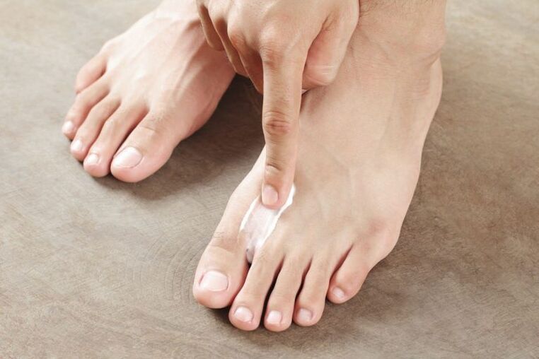 Application of antifungal cream on the skin of the foot