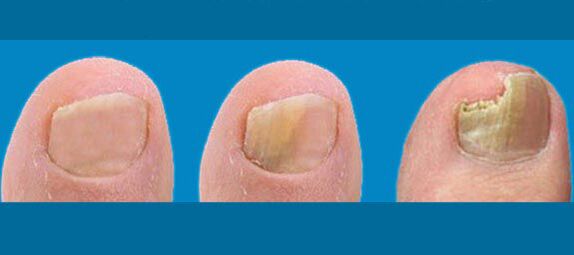 Nail fungus phase