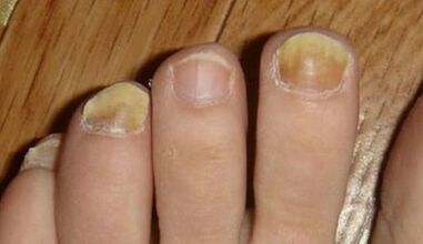 The causes of the apparition of the mushroom on the nails
