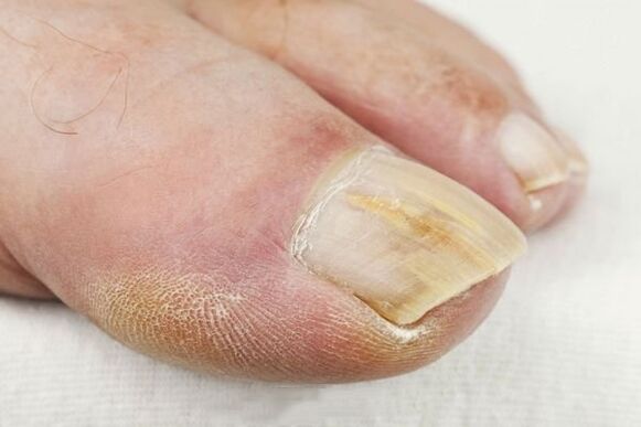 The consequences of the fungal lesions