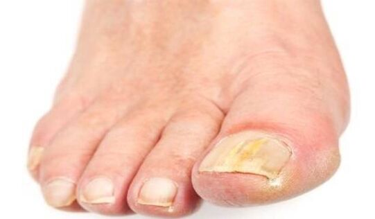 yellowing of nails due to fungal infections