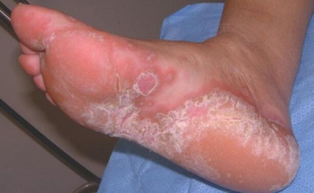 foot fungus symptoms