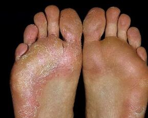 foot injury with fungus