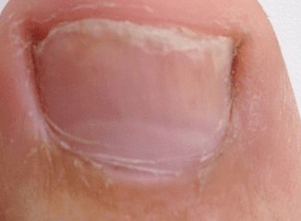 photo of the early stage of toenail fungus
