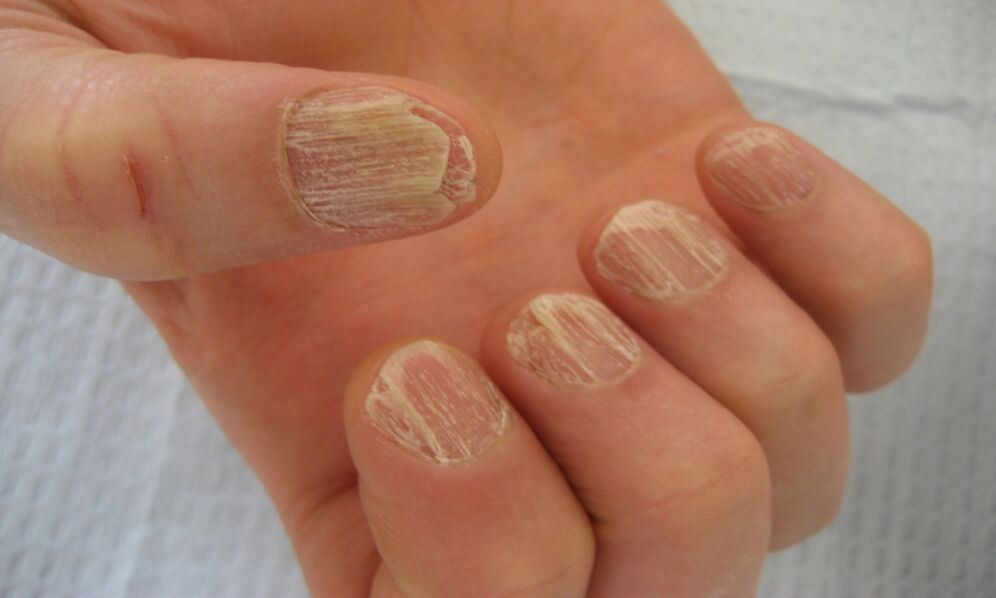 advanced stage of nail bending