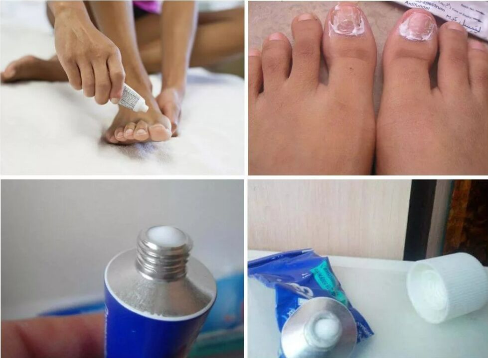medicine for toenail fungus