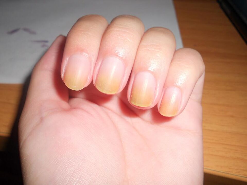 symptoms of nail fungus