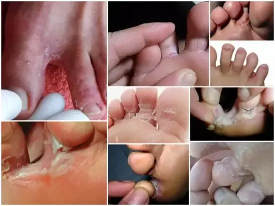 symptoms of fungus between toes photo 1