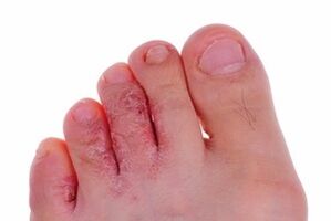 skin lesions due to fungi on the legs