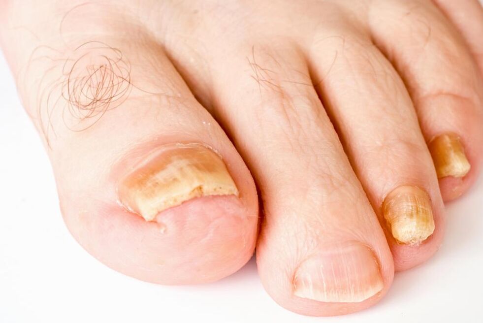 symptoms of nail fungus