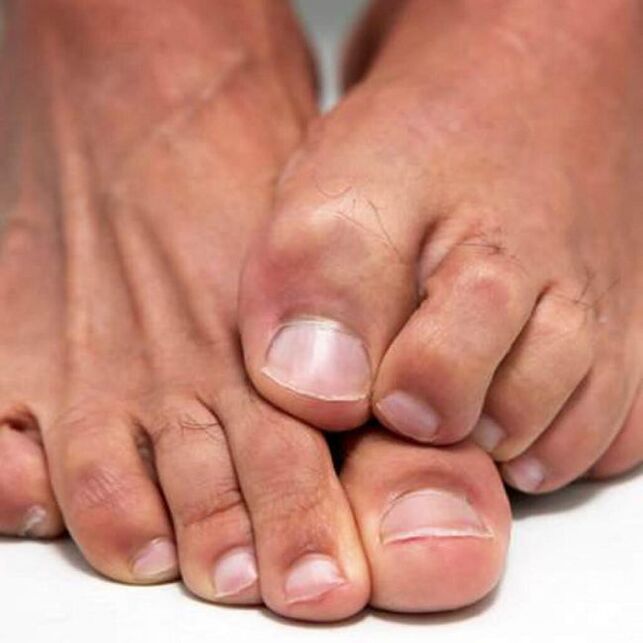 Fungi on the feet can cause itching