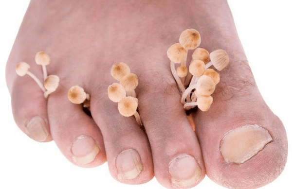 Fungal infection on feet