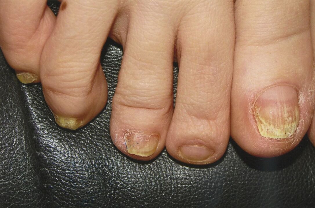 Fungus on toenails