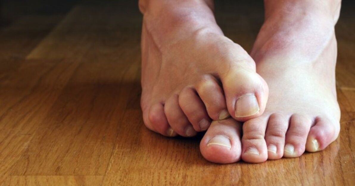 symptoms of fungus between toes