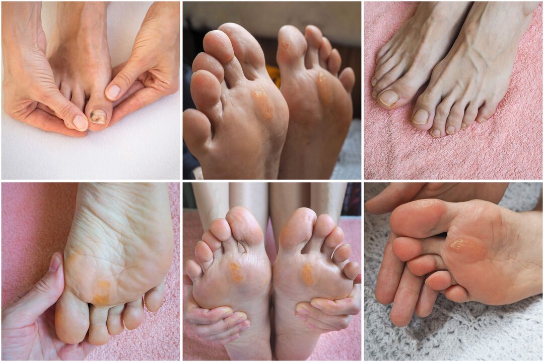 types of fungi on the feet